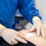 تعویض پانسمان کیست مویی - دکتر بتول طاهری