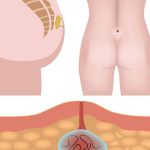 فرق کیست مویی و آبسه مقعد - دکتر بتول طاهری