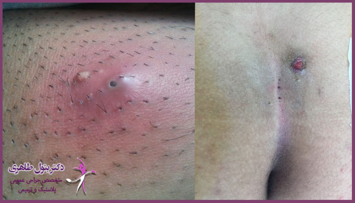 تشخیص کیست مویی از آبسه مقعدی