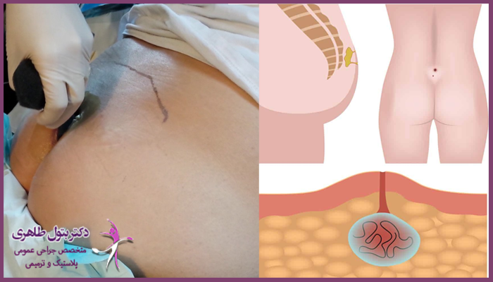 پانسمان کیست مویی چطور است؟