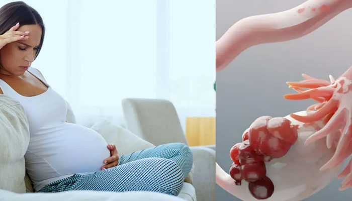 پیشگیری از کیست مویی در بارداری