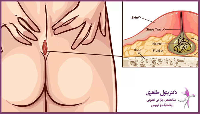 منظور از سینوس پیلونیدال چیست؟