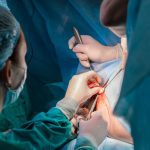 تنگی مقعد بعد از جراحی هموروئید - دکتر بتول طاهری