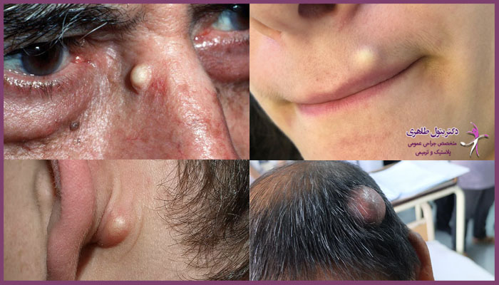 انواع کیست سباسه