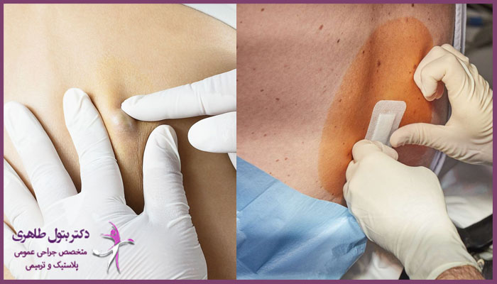 روند انجام عمل کیست مویی با لیزر