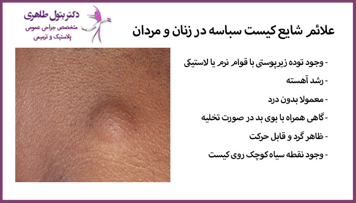 علائم شایع کیست سباسه در زنان و مردان